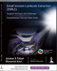 SMALL INCISION LENTICULE EXTRACTION (SMILE) SURGICAL TECHNIQUE AND CHALLENGES:COMPREHENSIVE TEXT